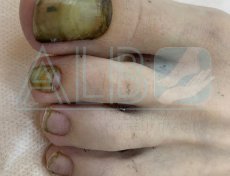 Виктория 17 лет. Грибог ногтя. Востановление нгтевой пластины заняло один год